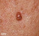 basal cell carcinoma