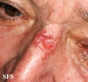 basal cell carcinoma