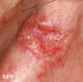 basal cell carcinoma