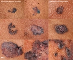 basal cell carcinoma