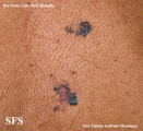 basal cell carcinoma