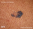 basal cell carcinoma
