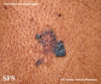 basal cell carcinoma
