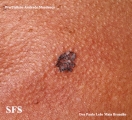 basal cell carcinoma