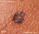basal cell carcinoma