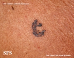 basal cell carcinoma