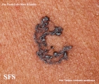 basal cell carcinoma