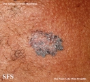 basal cell carcinoma