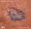 basal cell carcinoma