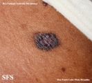 basal cell carcinoma