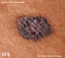 basal cell carcinoma