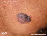 basal cell carcinoma