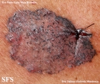 basal cell carcinoma