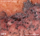 basal cell carcinoma