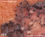 basal cell carcinoma