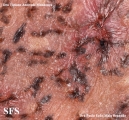 basal cell carcinoma