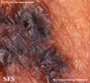 basal cell carcinoma