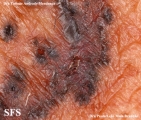 basal cell carcinoma
