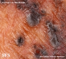 basal cell carcinoma