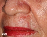 basal cell carcinoma