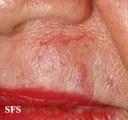 basal cell carcinoma