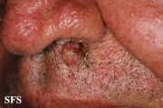 basal cell carcinoma