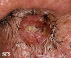 basal cell carcinoma
