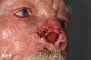 basal cell carcinoma