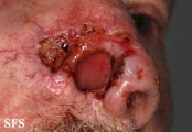 basal cell carcinoma