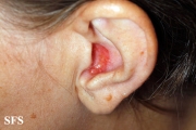 basal cell carcinoma