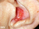 basal cell carcinoma