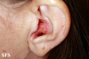 basal cell carcinoma