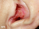 basal cell carcinoma