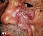 basal cell carcinoma