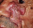 basal cell carcinoma