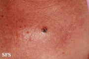 basal cell carcinoma