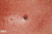 basal cell carcinoma