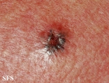 basal cell carcinoma