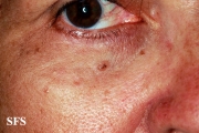 basal cell carcinoma