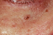 basal cell carcinoma