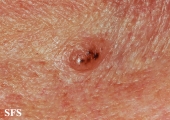 basal cell carcinoma