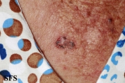 basal cell carcinoma