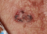 basal cell carcinoma