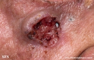 basal cell carcinoma