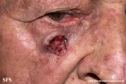 basal cell carcinoma