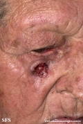 basal cell carcinoma