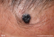 basal cell carcinoma