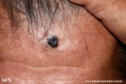 basal cell carcinoma