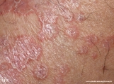 rhodotorula-cutaneos_rhodotorula