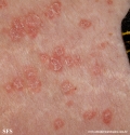 rhodotorula-cutaneos_rhodotorula